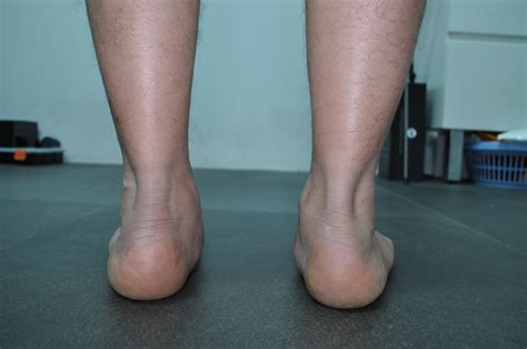 flat traducción|flat feet in spanish.